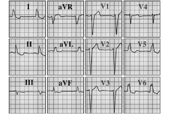 ECG answer 3