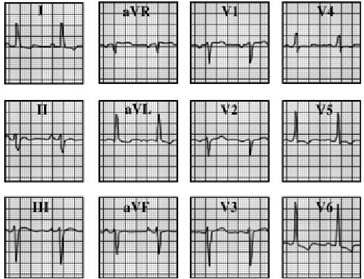 ECG answer 3