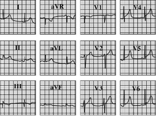 ecg